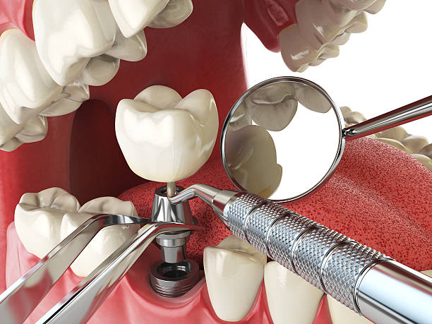 Best Lost Filling or Crown Replacement in Mullica Hill, NJ